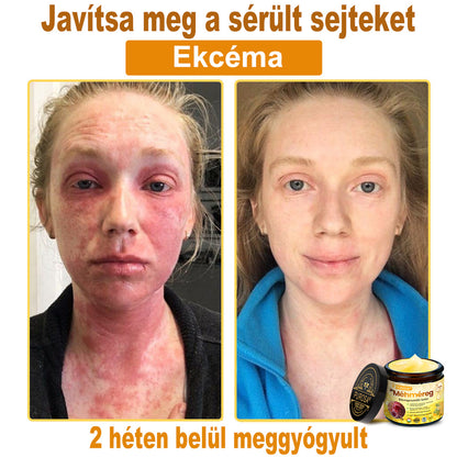 🐝PUROSA® Méhméreg Bőrmegújító Krém｜Teljes körű megoldás a makacs bőrproblémák, például az öregedés, ekcéma, hegek és pikkelysömör ellen
