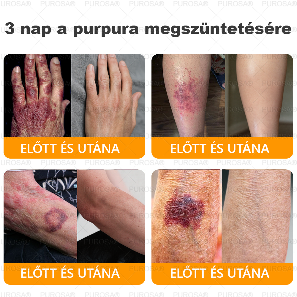 🐝 PUROSA® Méhméreg Fiatalító Krém｜ Átfogóan megoldja a makacs bőrproblémákat, mint például az öregedés, ekcéma, purpura, pikkelysömör stb.