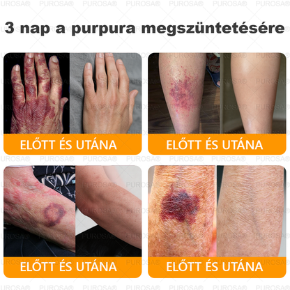 🐝 PUROSA® Méhméreg Fiatalító Krém｜ Átfogóan megoldja a makacs bőrproblémákat, mint például az öregedés, ekcéma, purpura, pikkelysömör stb.