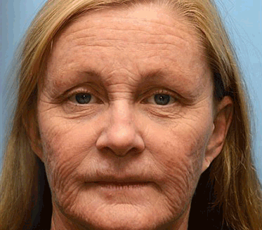 🐝 PUROSA® Méhméreg Fiatalító Krém｜ Átfogóan megoldja a makacs bőrproblémákat, mint például az öregedés, ekcéma, purpura, pikkelysömör stb.